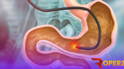 Mengenal Perkembangan Teknologi Endoskopi 7 endoskopi